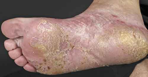 Ppp psoriasis bilder